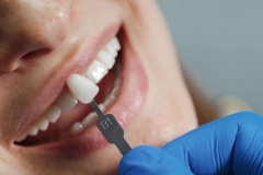 DentalCrowns-inr